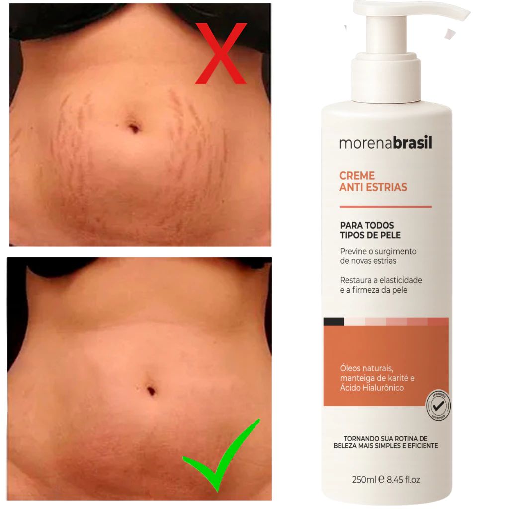 Creme Anti-Estrias - Diga Adeus às Estrias! Previne Novas Estrias & Reforça a Elasticidade Da Pele — análise em Produtos Review Online