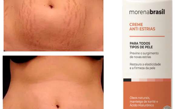 Creme Anti-Estrias JM-Cosmético: Vale a Pena? Análise 2026 - Todos os artigos